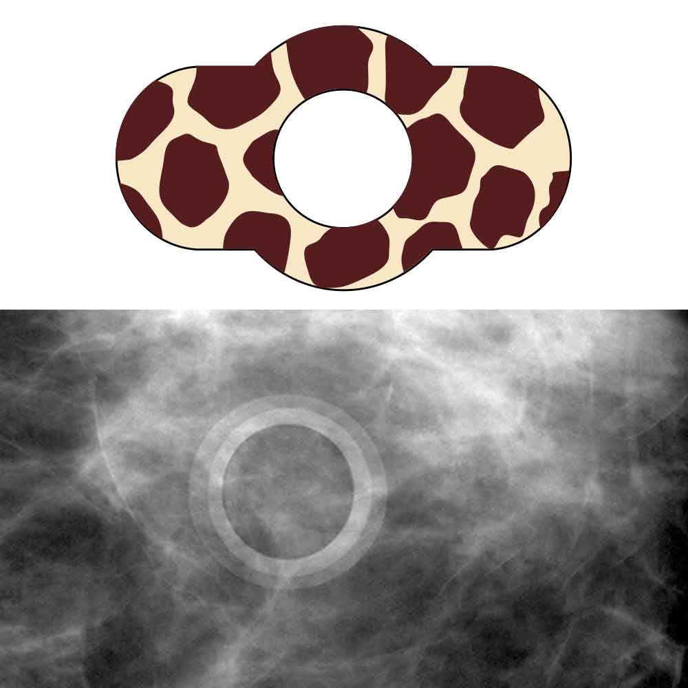 SPEE-D-RING™ MAMMOGRAPHY SKIN MARKER MOLE RADIOLUCENT NO BURNOUT™ GIRAFFE PRINT 1/2" INNER DIAMETER - 100 PER BOX